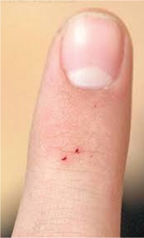 small bite mark